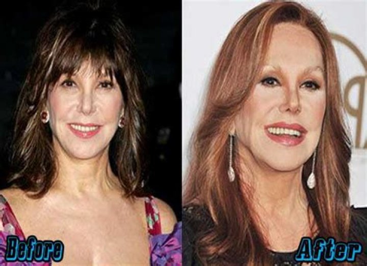 Exploring Marlo Thomas's Plastic Surgery Journey