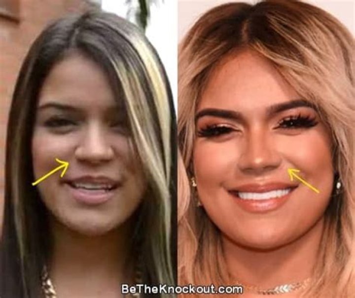 Unveiling Karol G's Plastic Surgery Journey: Discoveries And Revelations