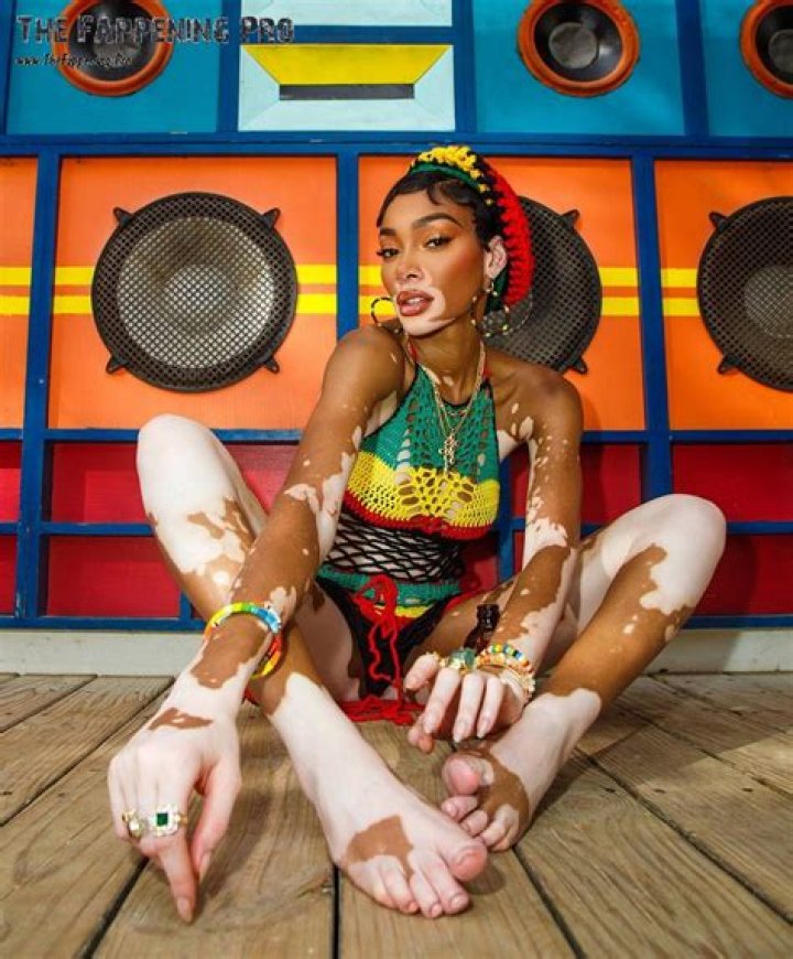 Embracing Beauty Beyond The Mask Of Vitiligo